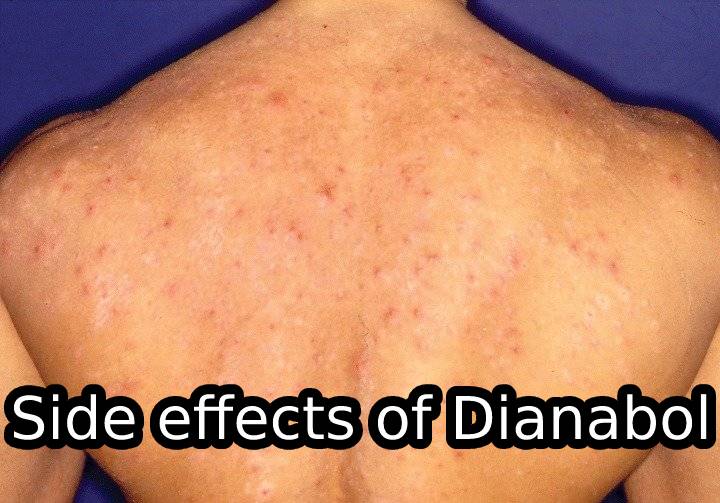 Side effects of Dianabol